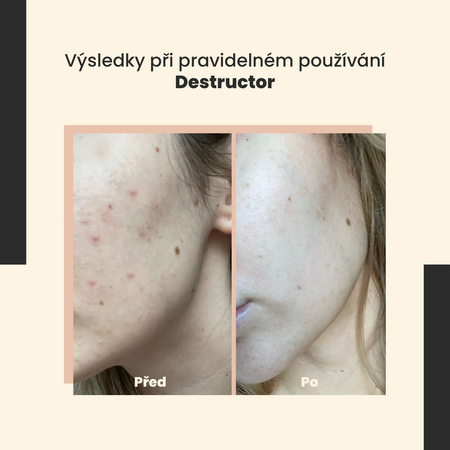SkinTra - Destructor - Celoroční kyselinový peeling 24 % - 30 ml