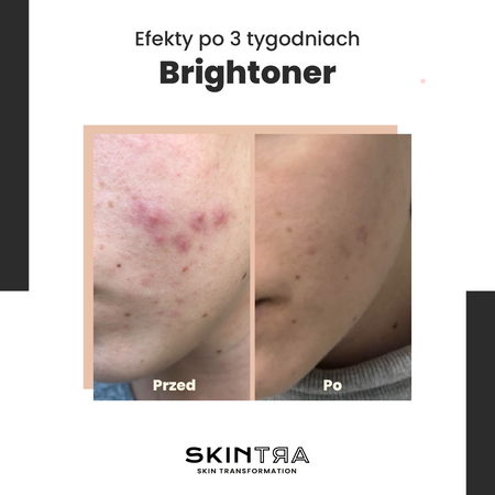 SkinTra - Brightoner - Celoroční kyselinové tonikum 9% - 100 ml